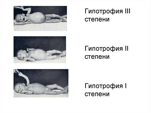 Реферат: Физическое, психомоторное развитие и состояние иммунной реактивности у детей, в зависимости от характера вскармливания на первом году жизни Реферат: Физическое, психомоторное развитие и состояние иммунной реактивности у детей, в зависимости от характера вскармливания на первом году жизни