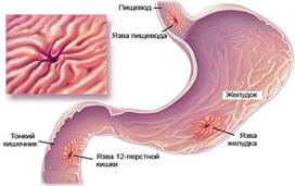 Статистика заболеваемости язвенной болезни в россии